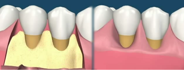 Ilustración de recesión gingival de clase 1